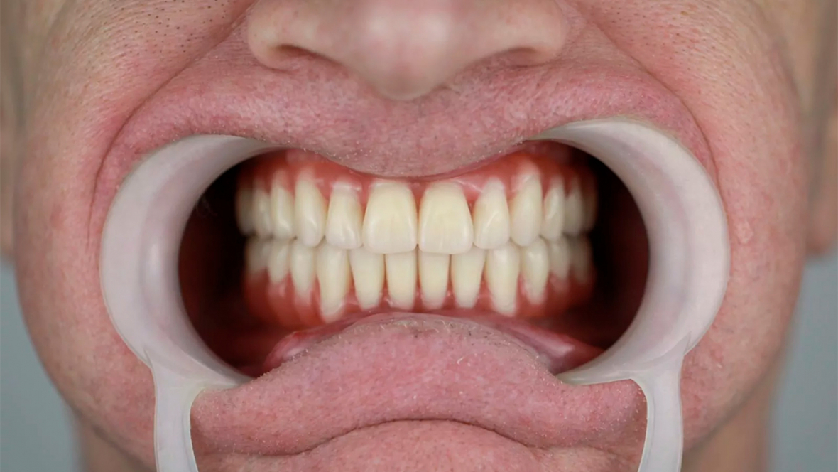 Зубы за один день в стоматологии